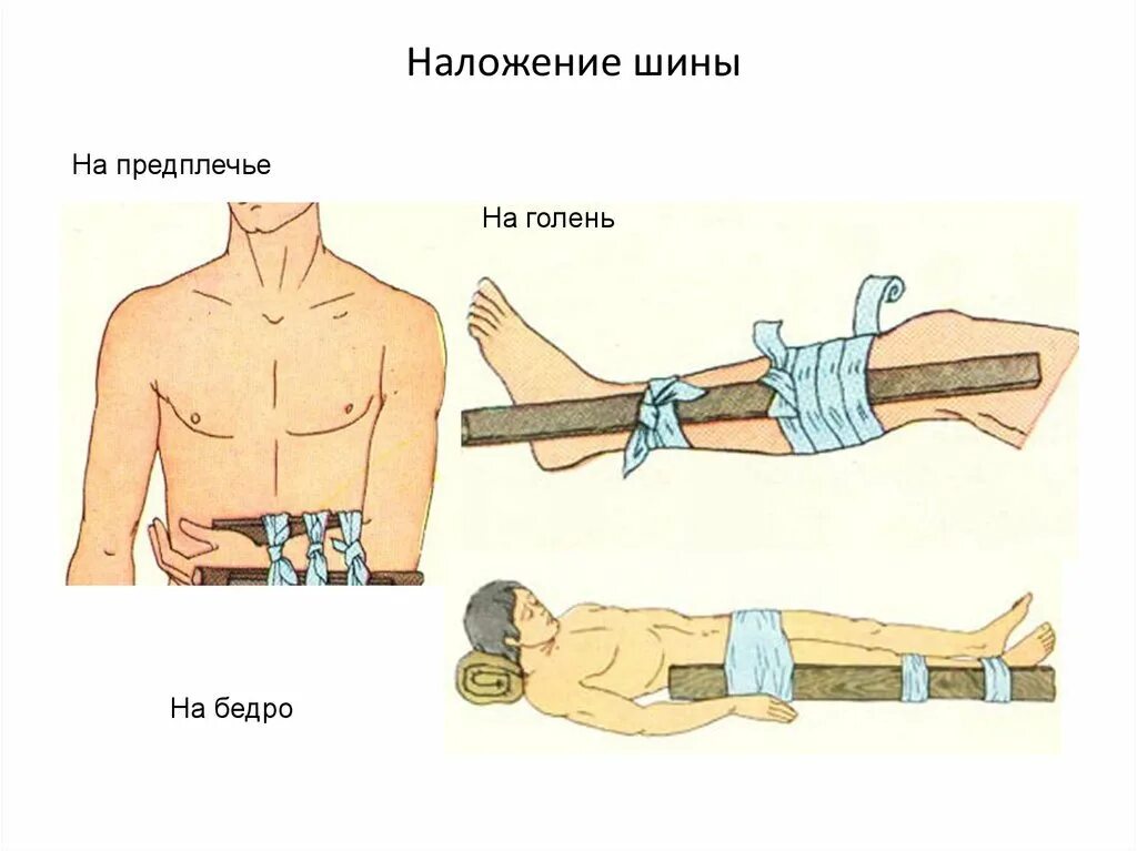 Наложение шины при переломе