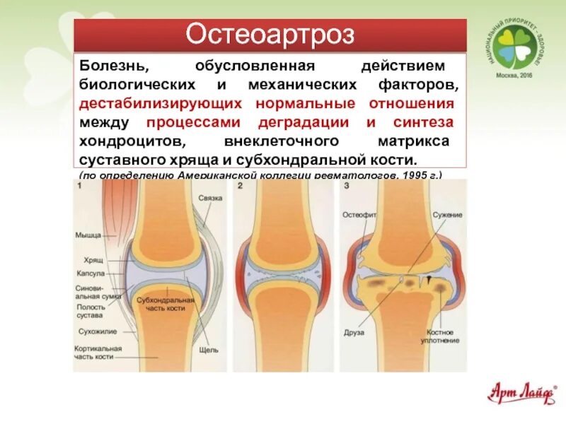 Склероз суставных. Субхондральный остеоартроз. остеоартроз базисная терапия. субхондральные отделы тазобедренного сустава. субхондральный остеосклероз суставных поверхностей.