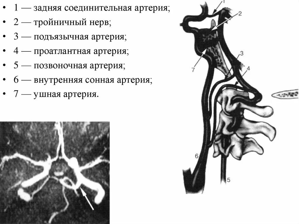 Задняя соединительная артерия мозга. Задняя соединительная артерия. Передние соединительные артерии. Устье задней соединительной артерии. Задняя соединительная артерия задняя соединительная артерия.