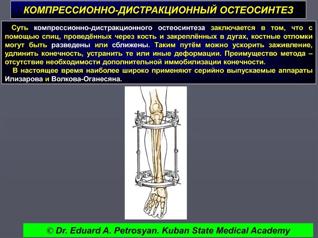 Компрессионный остеосинтез. Компрессионный остеосинтез. Стержневые аппараты внеочагового остеосинтеза. Компрессионный остеосинтез. Внеочаговый чрескостный остеосинтез.