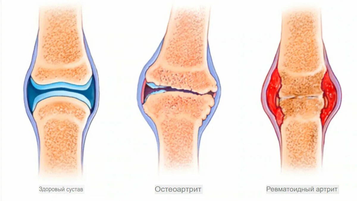 Артрит это. Ревматоидный артрит колена. Остеоартрит и ревматоидный артрит. Ревматоидный артрит и артроз. Ревматоидный артрит скелет.