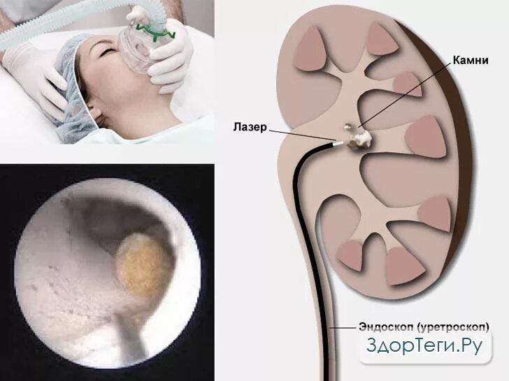 Эндоскопические операции камни в почках. Эндоскопическая операция почки. Операция на почки во убиранию камней. Как вывести камни без операции