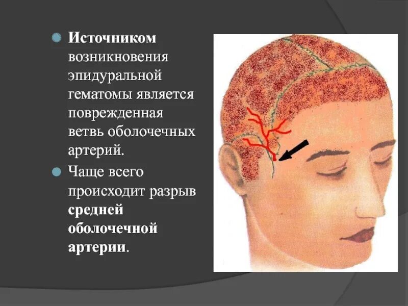 Сотрясение глаза. ЧМТ повреждения костей черепа. Черепно мозговая травма с переломом костей черепа. Открытые черепно мозговые травмы. Открытая черепно-мозговая травма, перелом основания черепа.