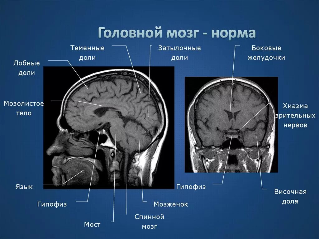 Мрт норма анатомия головного мозга. Мозолистое тело анатомия мрт. Мрт головного мозга сагиттальная проекция. Мрт мозга Сагиттальный срез.