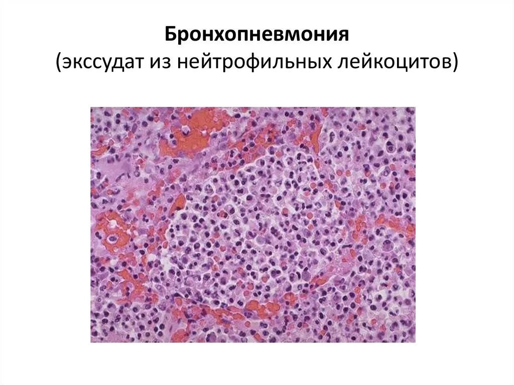 Бронхопневмония Гнойный экссудат. Гнойная бронхопневмония микропрепарат. Серозная бронхопневмония. Очаговая пневмония микропрепарат.