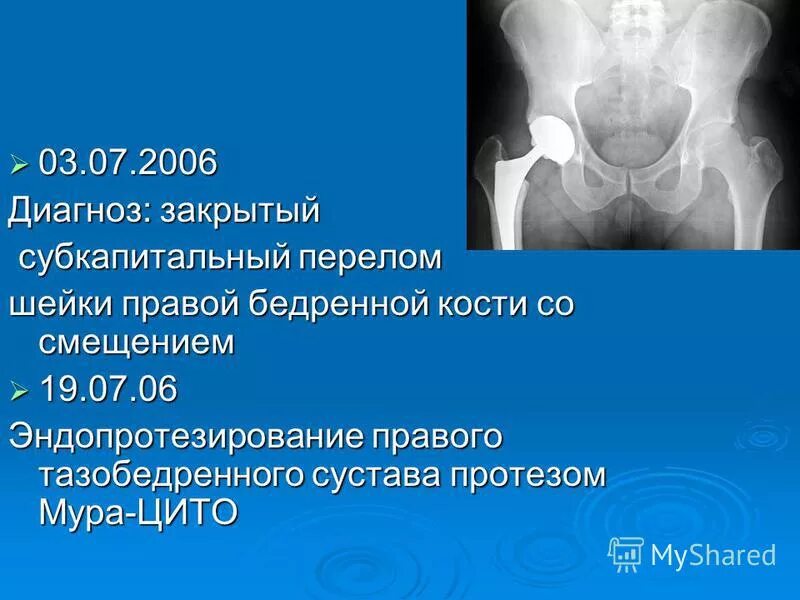 Мкб 10 закрытый перелом шейки. Закрытый субкапитальный перелом шейки правой бедренной кости. перелом шейки бедра диагноз. субкапитальный перелом шейки правой бедренной кости. перелом шейки бедра формулировка диагноза.