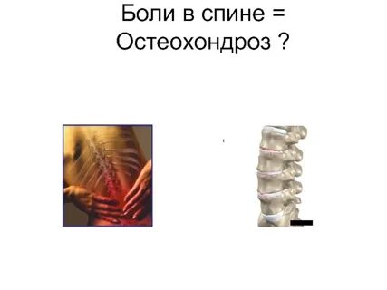 Слово остеохондроз