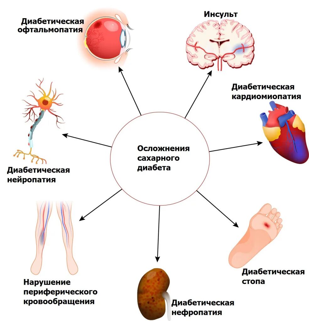 Симптомы сахара у человека. Осложнения сахарного диабета схема. Осложнения сахарного диабета 2 типа схема. Осложнения СД 1 типа и 2 типа. Осложнения сахарного диабета 1 типа и 2 типа.