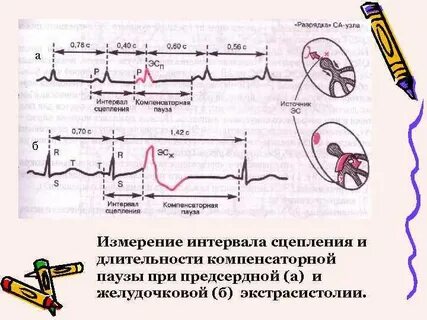 Пауза на экг