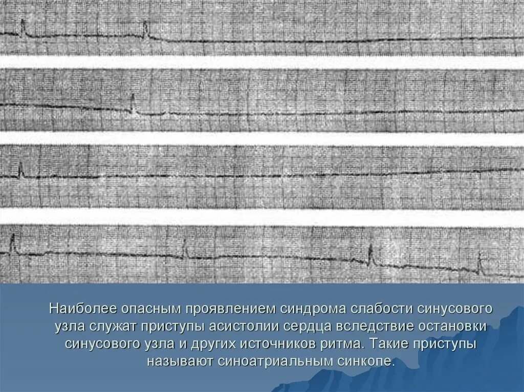 Слабость синусового узла код по мкб 10. Критерии сссу. асистолия синусового узла. синдром слабости синусового узла экг. синдром слабости синусового узла симптомы.