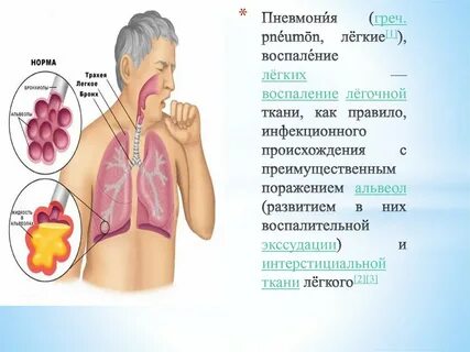 Бактериальная двусторонняя пневмония