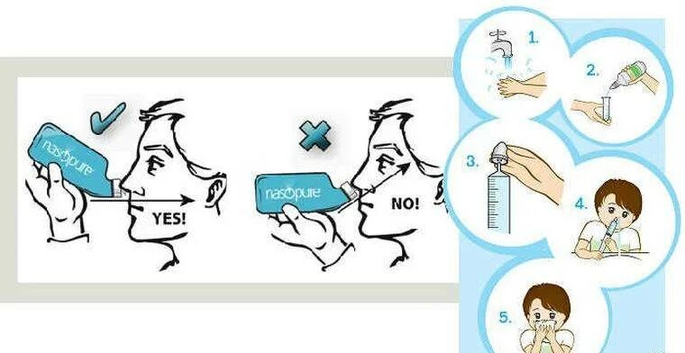 Как правильно промывать нос шприцом видео. Как правильно промывать нос солевым раствором из шприца. Промывание носа солевым раствором схема. Как правильно промывать нос солевым раствором из спринцовки. Как правильно промывать нос соляным раствором из шприца.