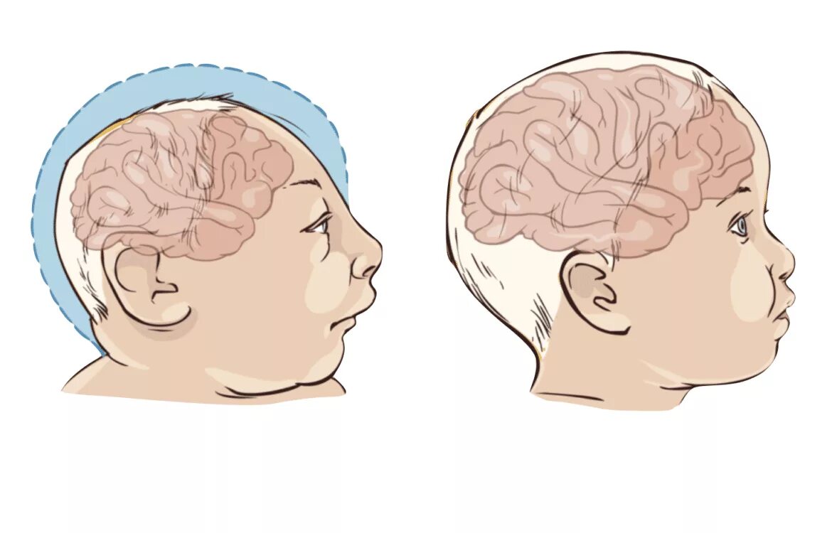 Недоразвитие зон мозга. Микроцефалия врождённый токсоплазмоз. Микроцефалия головного мозга. Микроцефалия окружность головы. Микроцефалия голова ребенка.