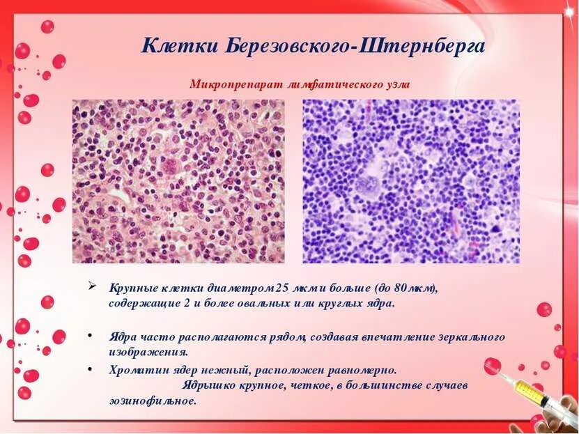 Рид штернберга. Клетки Березовского-Штернберга. Клетки Рида Березовского Штернберга. Клетки типа Березовского-Штернберга.