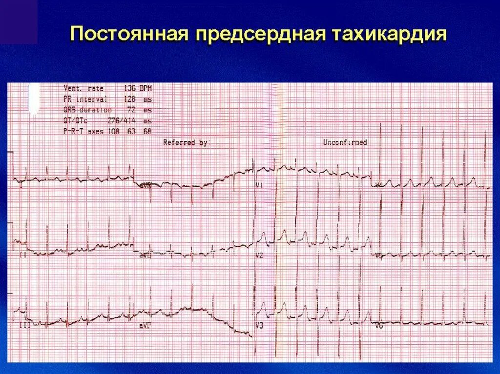 Экг-критерии пароксизмальной предсердной тахикардии. Предсердная пароксизмальная тахикардия на экг. Очаговая предсердная тахикардия на экг. Полиморфная предсердная тахикардия на экг. Фокусная предсердная тахикардия.