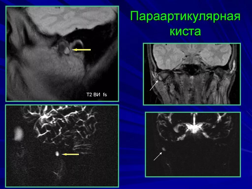 Аневризмальная киста позвонка. Синовиальная киста позвоночника l5 s1. Аневризмальная костная киста позвоночника мрт. Параартикулярная киста поясничного отдела позвоночника. Параартикулярная киста поясничного отдела позвоночника.
