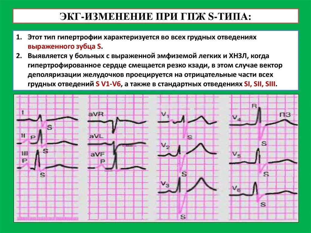 Нарастание зубца r. S Тип гипертрофии правого желудочка на ЭКГ. Гипертрофия правого желудочка r Тип s Тип. Гипертрофия правого желудочка r Тип на ЭКГ. S1 s2 s3 Тип ЭКГ.