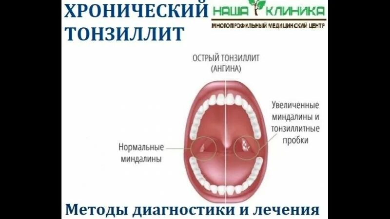 Тонзиллит код по мкб у взрослых. Фолликулярная — острый гнойный тонзиллит. фолликулярный фарингит. клинические проявления тонзиллита. хроническое заболевание горла тонзиллит.