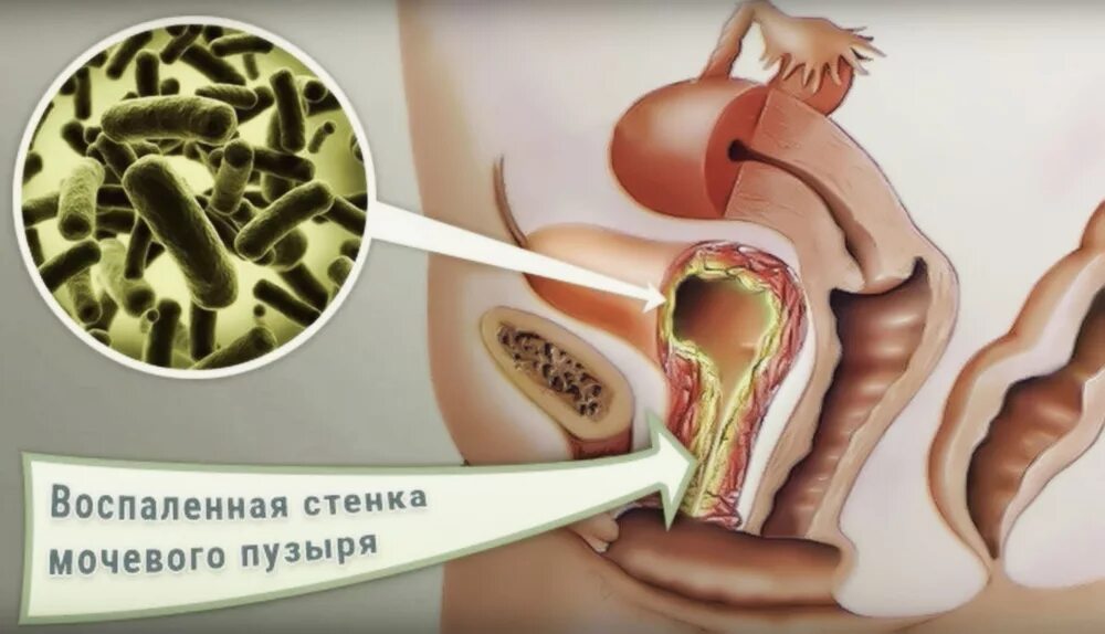 Чем грозит воспаление. Цистит вызывается бактериями. Цистит воспаление мочевого пузыря. Воспаление стенки мочевого пузыря.