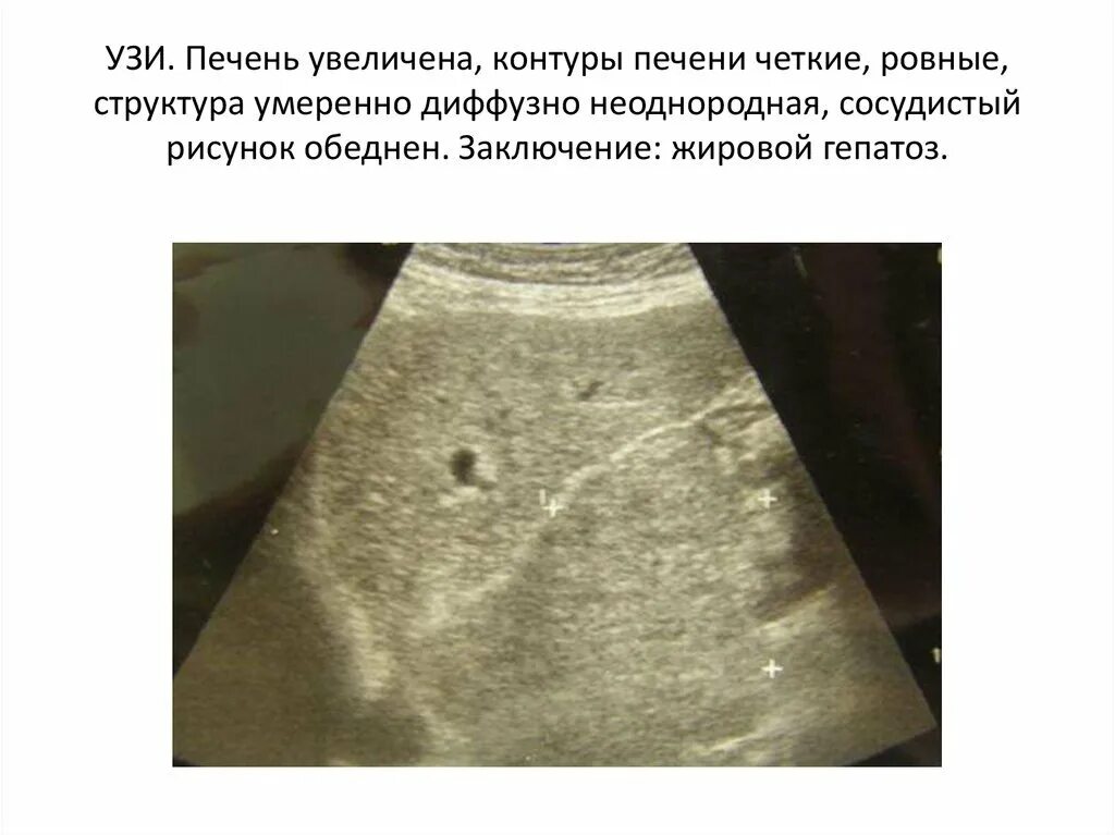 Диффузные изменения сосудов