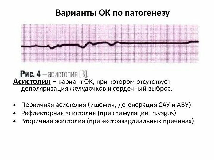 Асистолия что это. Асистолия на ЭКГ. Асистолия желудочков на ЭКГ. Асистолия предсердий на ЭКГ. Асистолия на ЭКГ описание.