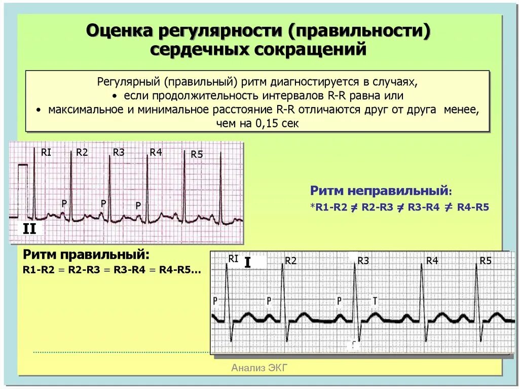 Синусовая тахикардия вертикальное. Правильный синусовый ритм на ЭКГ. Правильный и неправильный ритм на ЭКГ. Неправильный синусовый ритм. Синусовая Мерцательная аритмия ЭКГ.