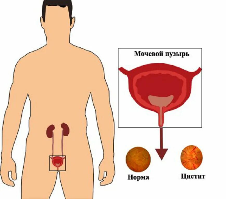 Симптомы мочевого пузыря у мужчин признаки. Воспаление мочевого пузыря у мужчин. Цистит у мужчин симптомы.