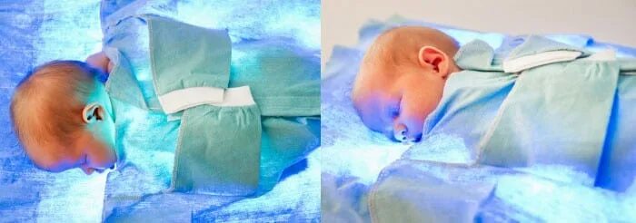 Лампа для фототерапии новорожденных. Фототерапия при желтухе. Лампа от желтушки в роддоме. Фототерапия желтухи у новорожденных.