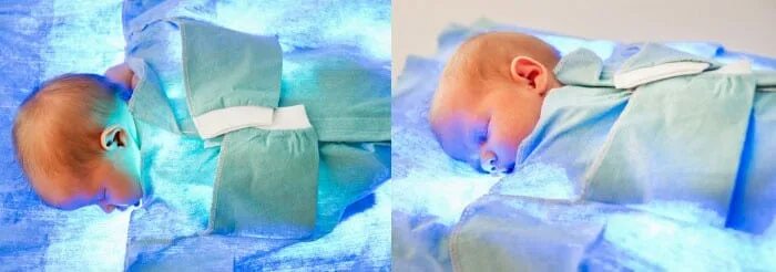 Сколько лежат под лампой при желтушке новорожденных. Лампа для фототерапии новорожденных. фототерапия при желтухе. лампа от желтушки в роддоме. фототерапия желтухи у новорожденных.
