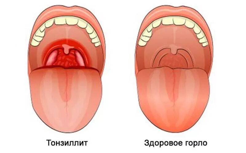 Как выглядит красное горло у взрослого