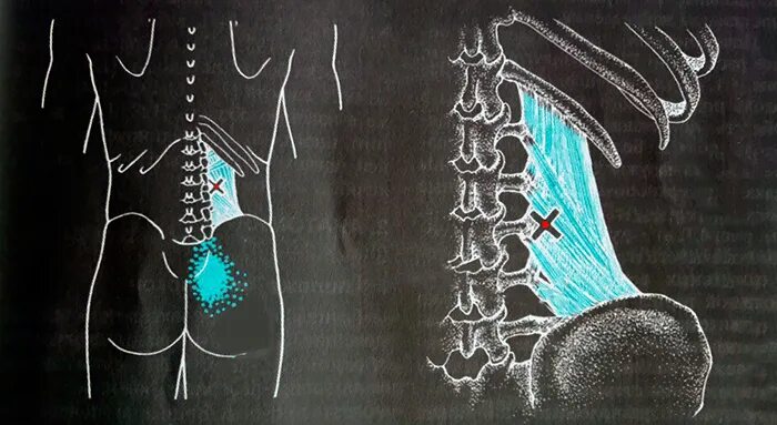Триггерные точки поясницы. Триггерные точки поясничного отдела позвоночника. Триггера в квадратной мышце поясницы. Поясничная мышца триггерные точки. Квадратная мышца триггерные точки.