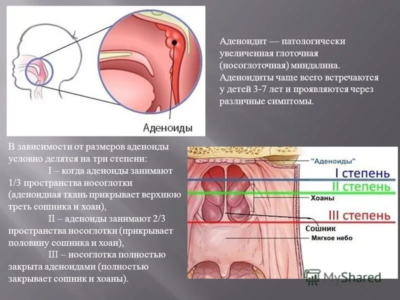 Аденоиды у ребенка 2 3 лет. Аденоиды это разрастание лимфоидной ткани. Носоглоточные аденоиды. Симптомы разросшихся аденоидов.