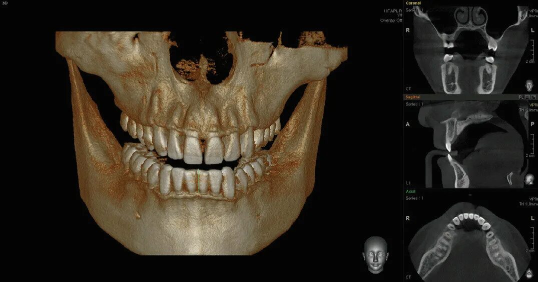 Где сделать кт зуба. Кт 3d верхней и нижней челюсти. 3д КЛКТ челюсти. 3д кт сканирование челюстной. Кт верхней челюсти и нижней челюсти.