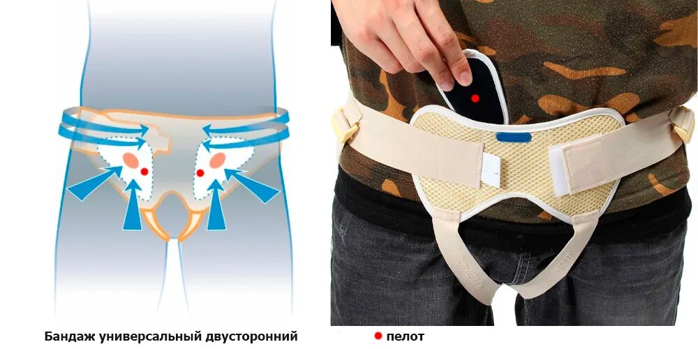 Как подобрать паховый бандаж. Бандаж паховый грыжевой timed ti-651. бандаж для паховой грыжи мужской орлетт нв-484 с жесткой фиксацией. бандажи для паховой грыжи у мужчин. бандаж для паховой грыжи мужской своими руками.