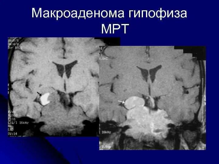 Макроаденома гипофиза. Макроаденоме гипофиза. макроаденома гипофиза мрт. микроаденома и макроаденома гипофиза. макроаденома гипофиза размер.