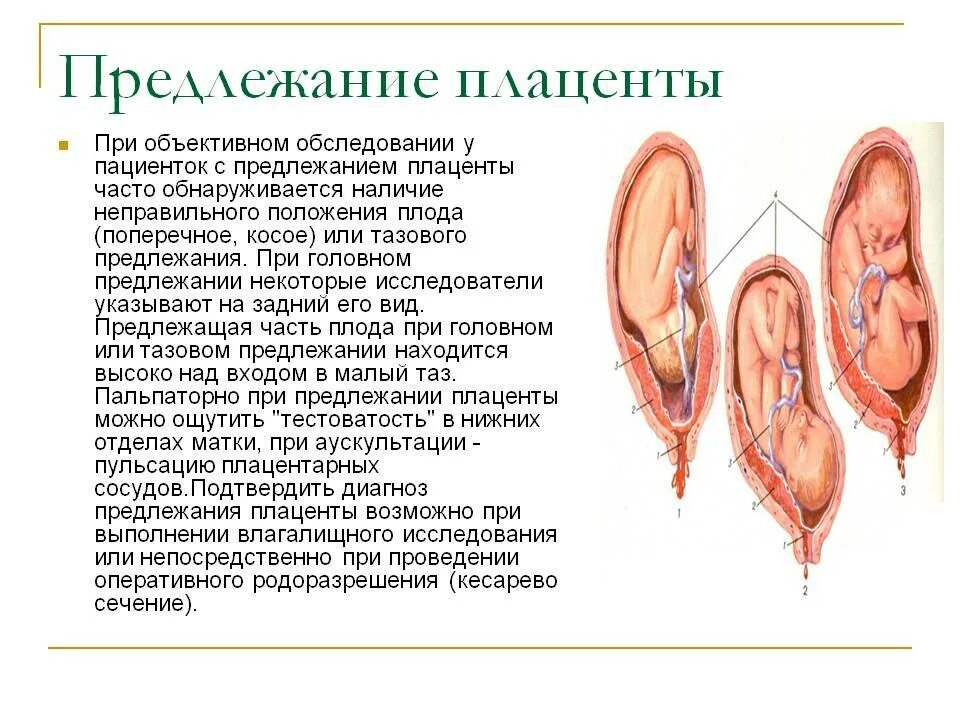 Краевое предлежание форум. Предлежание плаценты головное. краевое боковое центральное низкое предлежание плаценты. неправильное предлежание плаценты. плодовый фактор предлежания плаценты.