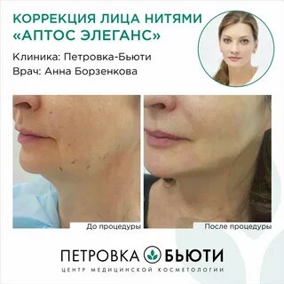 Коррекция нитями