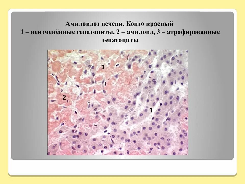 Саговый амилоидоз селезенки. Амилоидоз селезенки гистология. амилоидоз печени патанатомия. амилоидоз селезенки – саговая селезенка. амилоидоз печени микропрепарат конго красный.