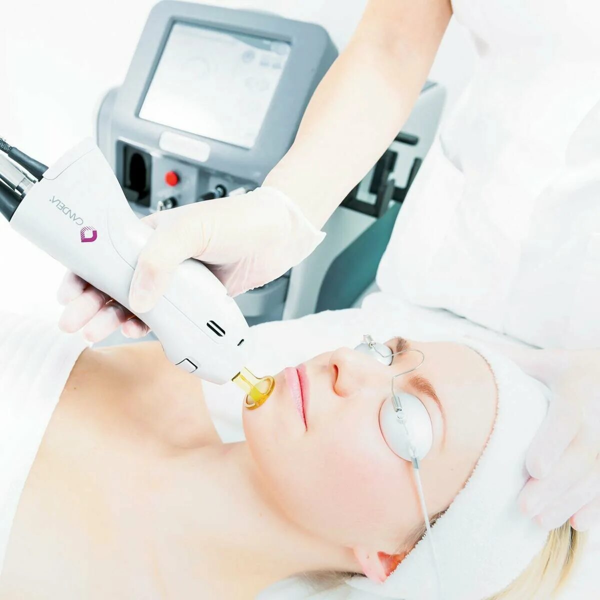 Лазерная эпиляция город. Candela gentlelase pro alexandrite laser hair removal. лазерный аппарат кандела. candela gentlelase pro-u. эпиляция candela gentlelase.