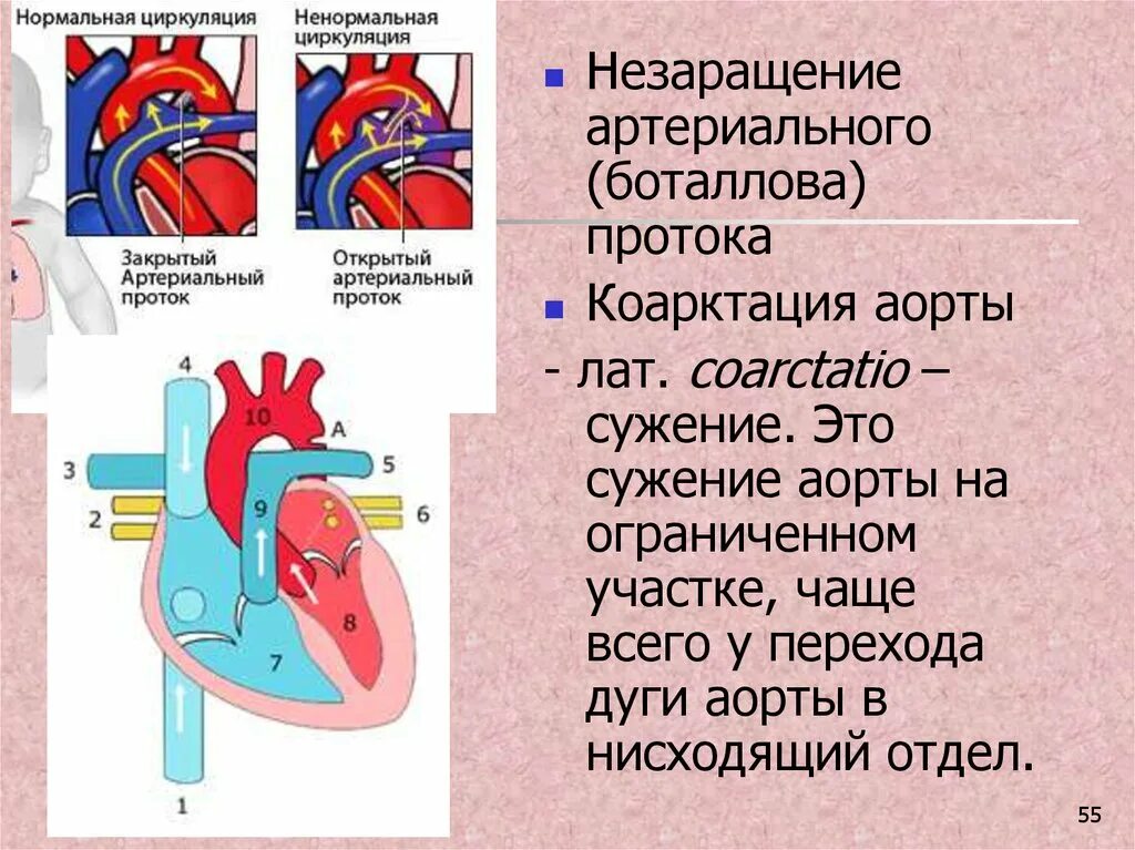 Персистирование боталлова протока. Открытый артериальный проток у новорожденных. незаращение боталлова протока схема. операции при незаращении боталлова протока. операции при незаращении боталлова протока схема.