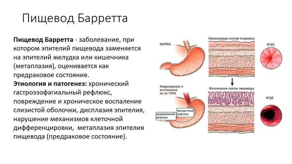 Пищевод Барретта патанатомия. Пищевод Барретта гистология. Пищевод Барретта метаплазия эпителия. Пищевод Баррета патогенез.