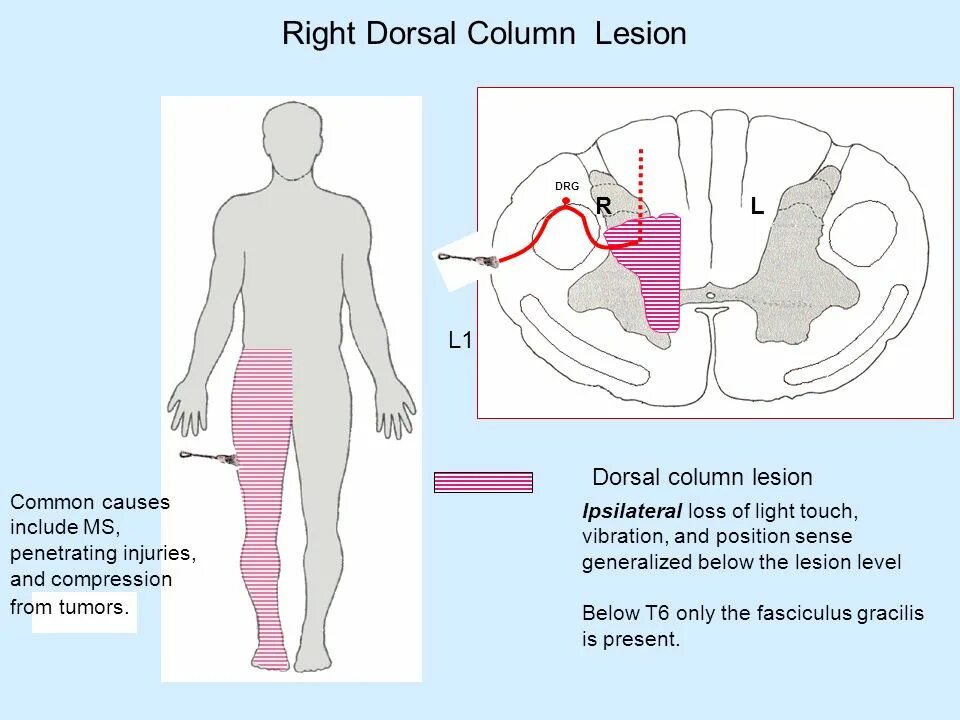 «тоten tract». Латерал спридинг тумор. Types of conflict resolution. Brown sequard. Spastic paresis is.