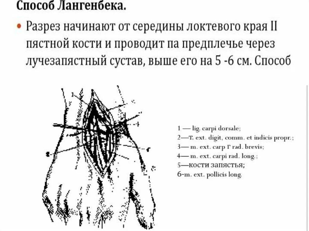 Артротомия плечевого сустава. Артротомия по Лангенбеку лучезап. Артротомия лучезапястного сустава. Пункция и артротомия лучезапястного сустава.. Артротомия верхней конечности.