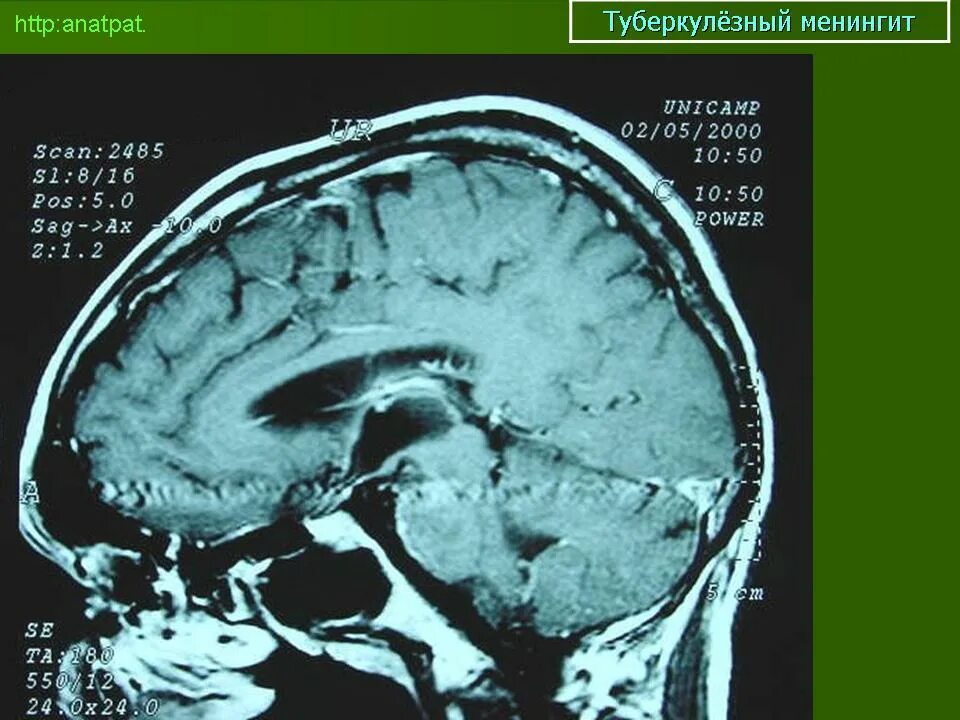 Туберкулез головного. Туберкулезный менингоэнцефалит. Туберкулезный менингит кт головного мозга. Туберкулез головного мозга кт. Туберкулезный менингоэнцефалит кт.