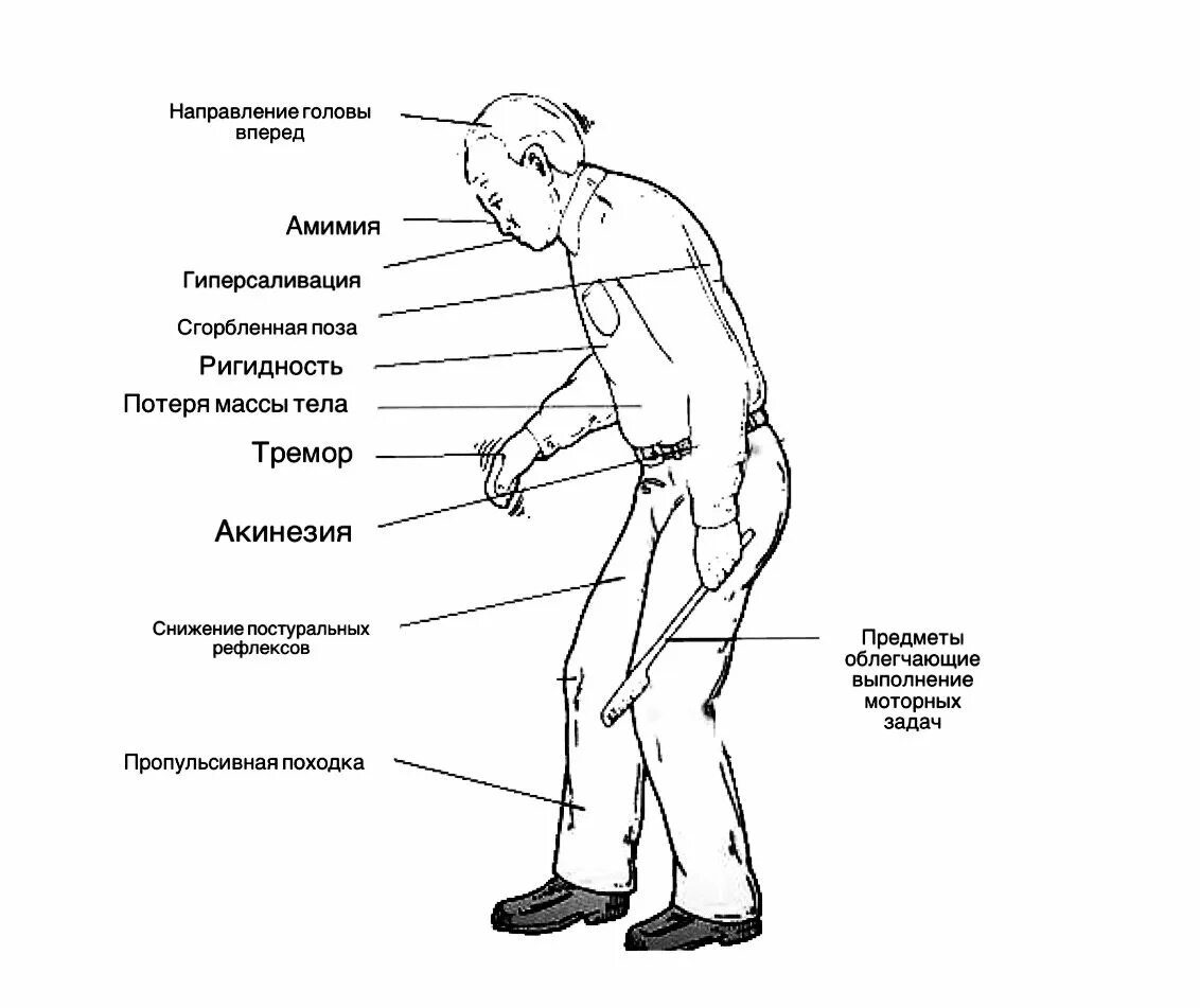 Болезнь паркинсона симптомы у пожилых
