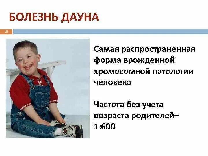 Детские генетические заболевания. Детская прогерия. Гипертелоризм эпикант. Генетические заболевания у детей. Наследственные заболевания прогерия.