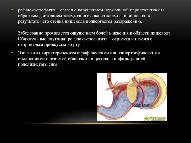 Атрофический рефлюкс. Желудочно-пищеводный рефлюкс этиология. Рефлюкс желудочного сока.