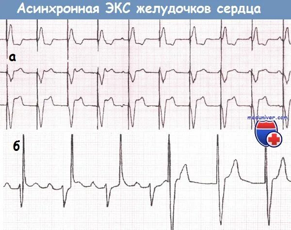 Имплантация сердца кардиостимулятор. Со экс. Электрокардиостимулятор экс-560-sr. Ритм экс vvi. Кардиостимулятор экс сетал 1в.