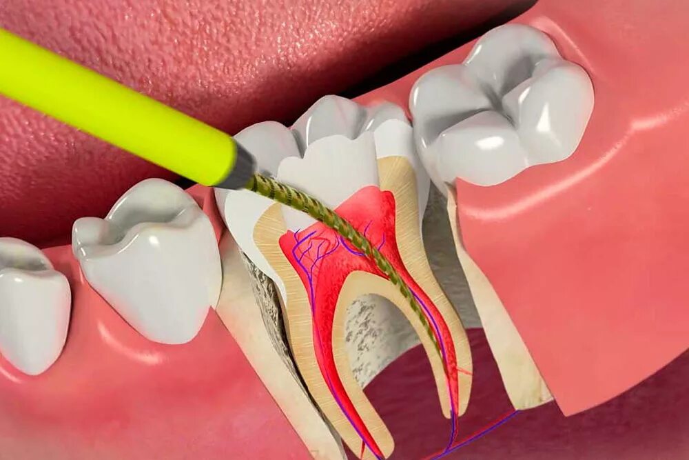 Root canal. Двухканальный пульпит. Пульпит пломбировка каналов.