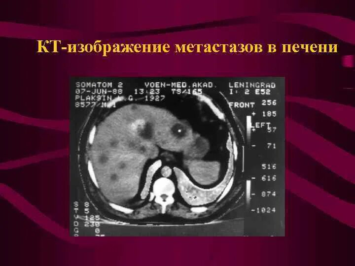 Гиперваскулярные метастазы печени кт. Рентгенодиагностика метастазов в печени. Вылечить метастазы в печени